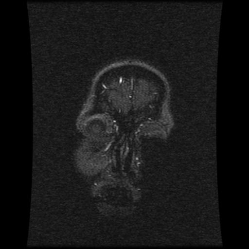 File:Cavernoma with developmental venous anomaly (Radiopaedia 22470-22507 MRV 118).jpg