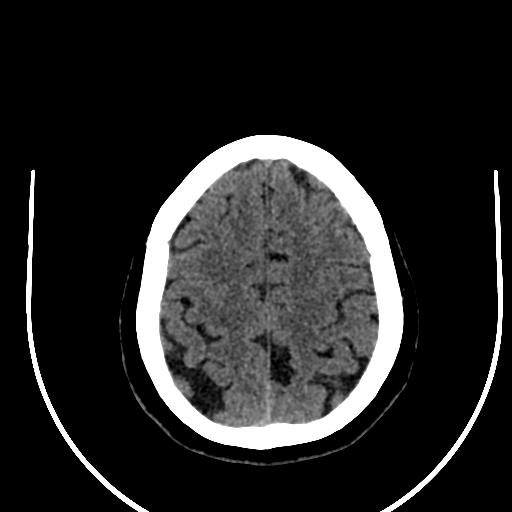 Cavernous hemangioma of the cerebellar falx (Radiopaedia 73025-83723 Axial non-contrast 108).jpg