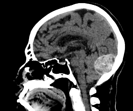 Cavernous hemangioma of the cerebellar falx (Radiopaedia 73025-83723 B 160).jpg