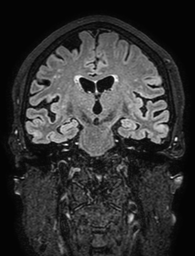 Cavernous hemangioma of the cerebellar falx (Radiopaedia 73025-83724 Coronal FLAIR 178).jpg