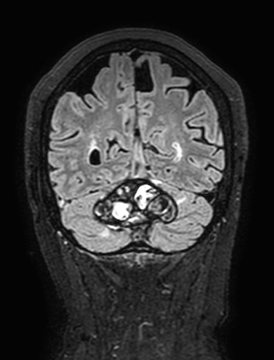 Cavernous hemangioma of the cerebellar falx (Radiopaedia 73025-83724 Coronal FLAIR 275).jpg