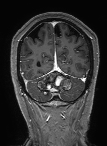 Cavernous hemangioma of the cerebellar falx (Radiopaedia 73025-83724 Coronal T1 C+ 300).jpg