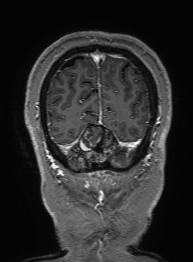 Cavernous hemangioma of the cerebellar falx (Radiopaedia 73025-83724 Coronal T1 C+ 332).jpg