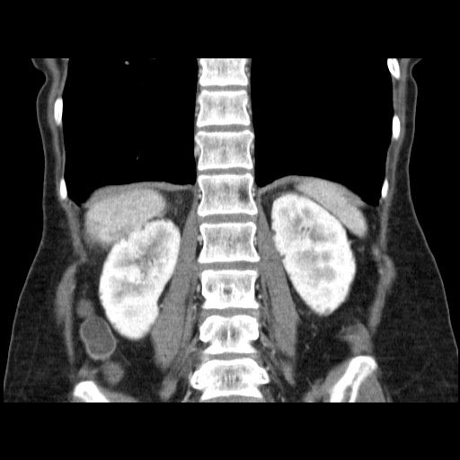 Cavernous hepatic hemangioma (Radiopaedia 75441-86667 C 105).jpg