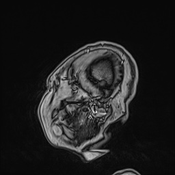 Cavernous sinus meningioma (Radiopaedia 63682-72367 Sagittal T1 C+ 25).jpg