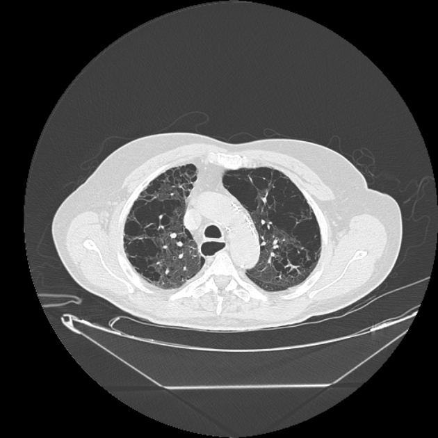 Cavitating bronchogenic carcinoma (Radiopaedia 44489-48162 Axial lung window 21).jpg