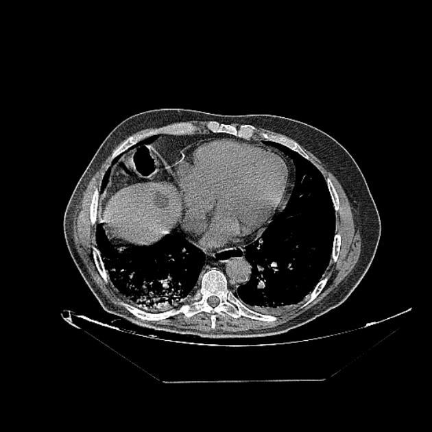 Cavitating bronchogenic carcinoma (Radiopaedia 44489-48162 Axial non-contrast 60).jpg