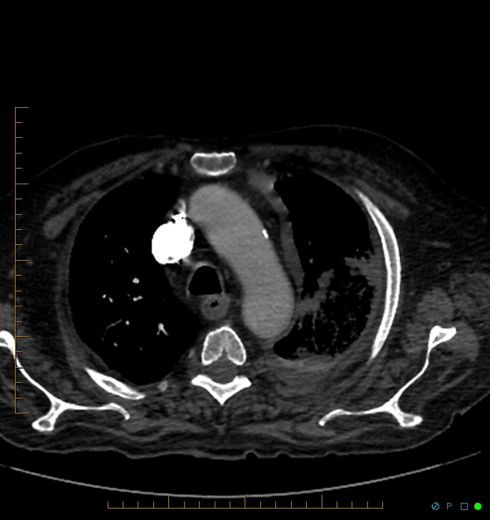 Cavitating pulmonary infarction (Radiopaedia 54634-60849 Axial C+ CTPA 13).jpg
