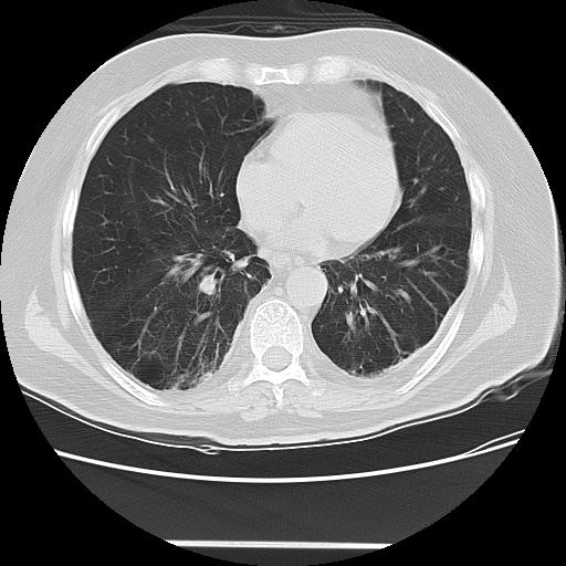 Cavitating pulmonary metastases (Radiopaedia 89545-106544 Axial lung window 37).jpg