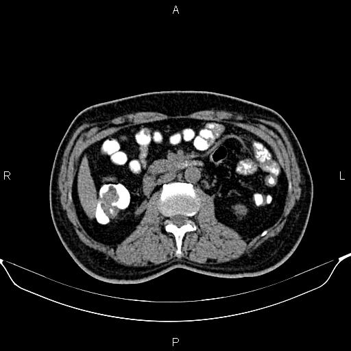 Cecal adenocarcinoma (Radiopaedia 85324-100916 Axial non-contrast 43).jpg