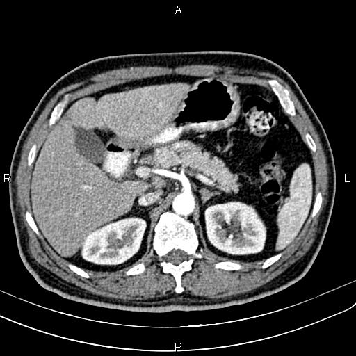 Cecal cancer with appendiceal mucocele (Radiopaedia 91080-108651 A 70).jpg