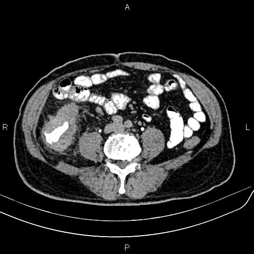 File:Cecal cancer with appendiceal mucocele (Radiopaedia 91080-108651 Axial C+ delayed 45).jpg