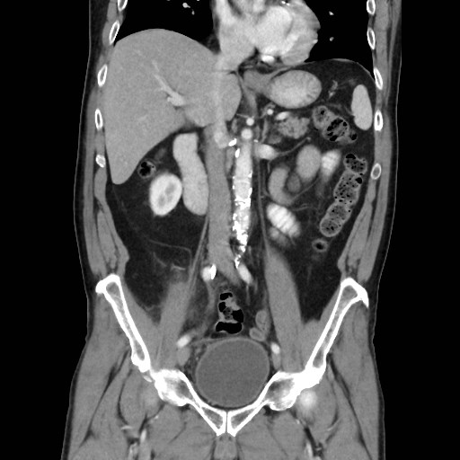 File:Cecal mass causing appendicitis (Radiopaedia 59207-66531 B 26).jpg
