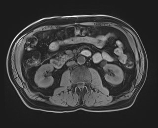 Cecal mass causing appendicitis (Radiopaedia 59207-66532 Axial T1 65).jpg