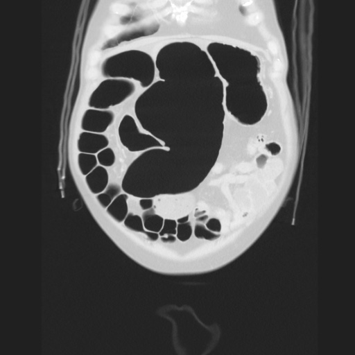 Cecal volvulus (Radiopaedia 75378-86620 Coronal lung window 35).jpg