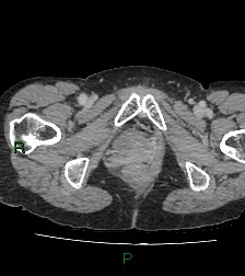 Cecal volvulus (Radiopaedia 86741-102900 A 139).jpg