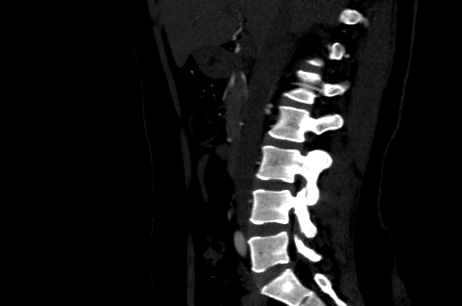 File:Celiac artery compression syndrome (Radiopaedia 47538-52152 B 8).jpg