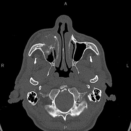 File:Central giant cell granuloma (Radiopaedia 83346-97761 Axial bone window 36).jpg