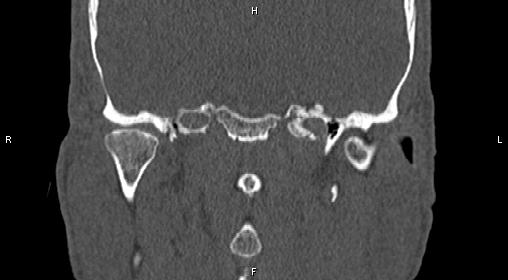 File:Central giant cell granuloma (Radiopaedia 83346-97761 Coronal bone window 30).jpg
