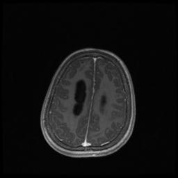 Central neurocytoma (Radiopaedia 30220-30842 Axial T1 C+ 117).jpg