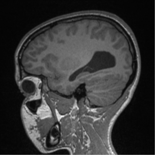 Central neurocytoma (Radiopaedia 37664-39557 Sagittal T1 29).png