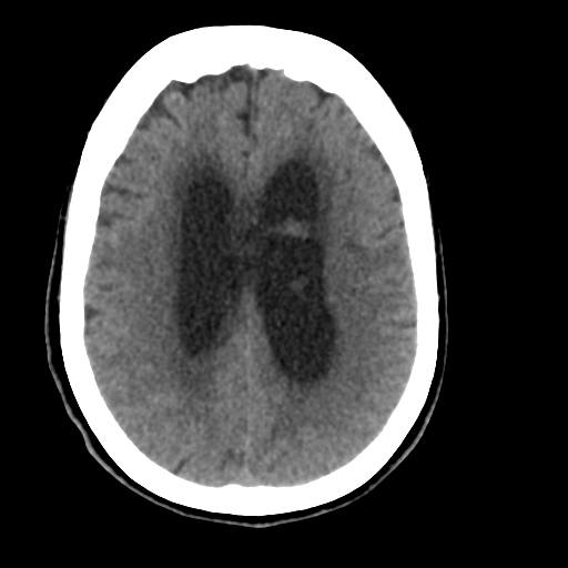 Central neurocytoma (Radiopaedia 65317-74346 Axial non-contrast 33).png