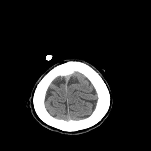 Central neurocytoma (Radiopaedia 68725-78432 Axial non-contrast 50).jpg