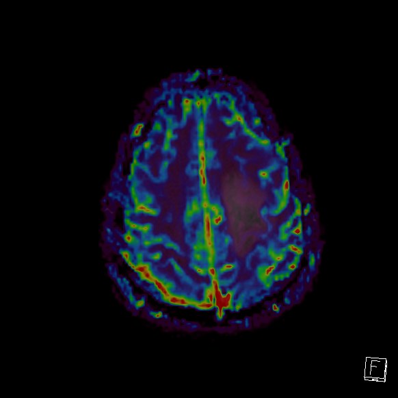 Central neurocytoma (Radiopaedia 84497-99872 Axial Perfusion 60).jpg