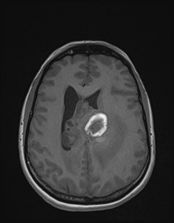 Central neurocytoma (Radiopaedia 84497-99872 Axial T1 128).jpg