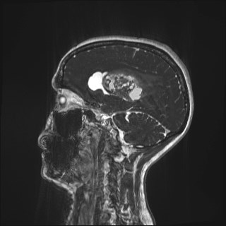 Central neurocytoma (Radiopaedia 84497-99872 Sagittal CISS 26).jpg