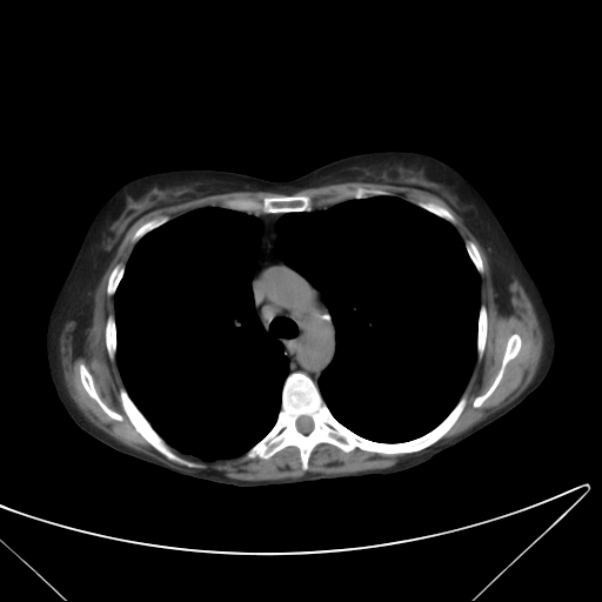 Centrilobular pulmonary emphysema (Radiopaedia 24495-24789 Axial non-contrast 18).jpg