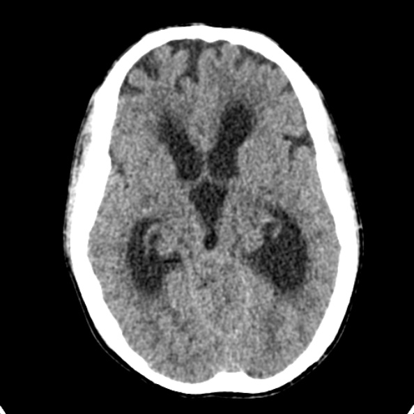Cerebellar abscess secondary to mastoiditis (Radiopaedia 26284-26412 Axial non-contrast 69).jpg