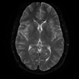 Cerebellar hemangioblastoma (Radiopaedia 29570-30077 Axial DWI 40).jpg