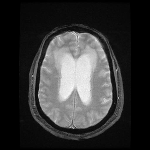 File:Cerebellar hemangioblastoma (Radiopaedia 88055-104622 Axial Gradient Echo 14).jpg