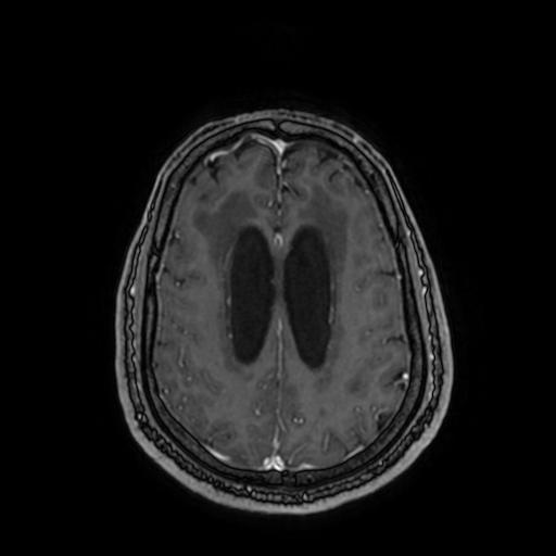 Cerebellar hemangioblastoma (Radiopaedia 88055-104622 Axial T1 C+ 127).jpg