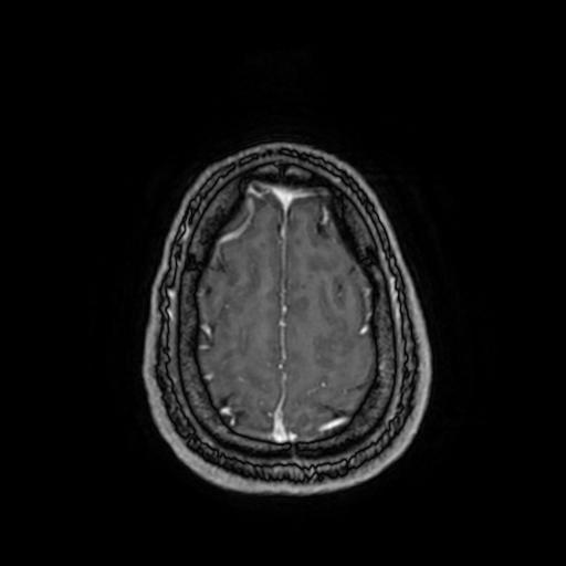 Cerebellar hemangioblastoma (Radiopaedia 88055-104622 Axial T1 C+ 150).jpg