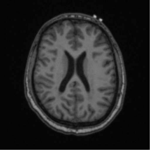 Cerebellar hemangioblastomas and pituitary adenoma (Radiopaedia 85490-101176 Axial T1 46).png