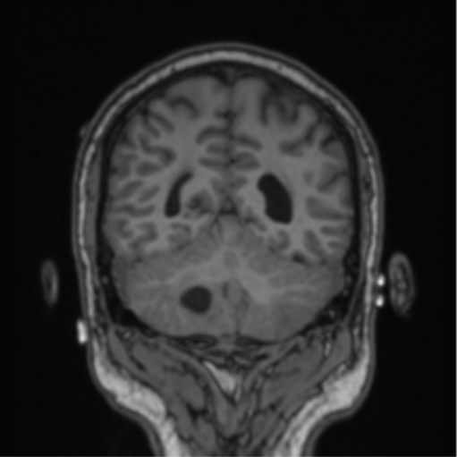 File:Cerebellar hemangioblastomas and pituitary adenoma (Radiopaedia 85490-101176 Coronal T1 31).png