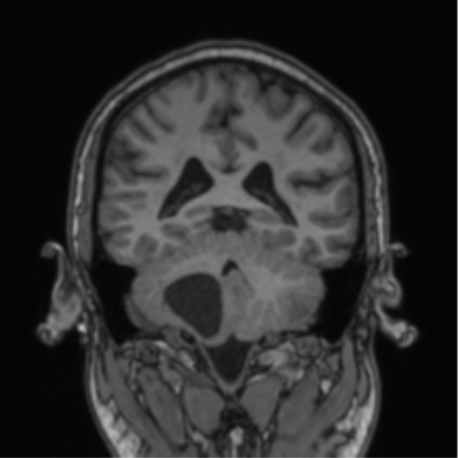 File:Cerebellar hemangioblastomas and pituitary adenoma (Radiopaedia 85490-101176 Coronal T1 37).png