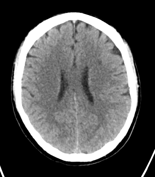 File:Cerebellar hemorrhage (Radiopaedia 37000-38669 Axial non-contrast 25).png