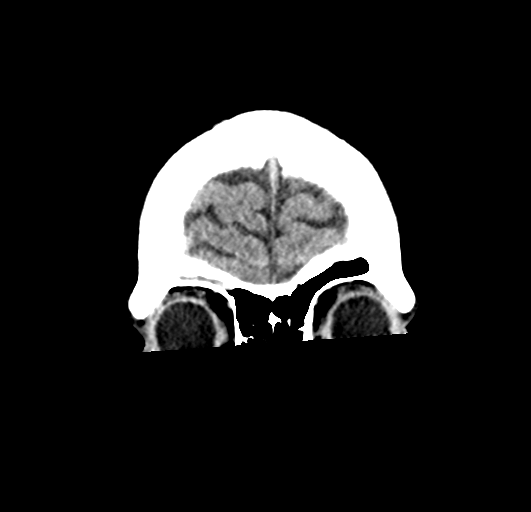 File:Cerebellar infarct due to vertebral artery dissection with posterior fossa decompression (Radiopaedia 82779-97033 Coronal non-contrast 7).png
