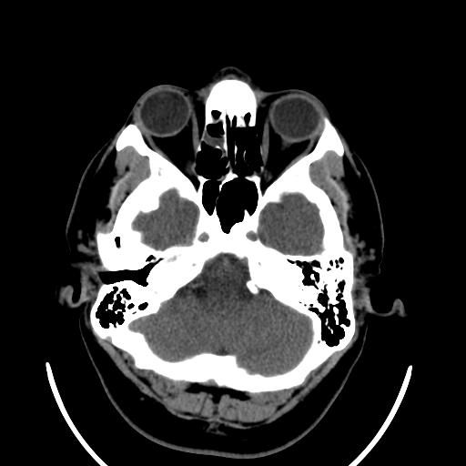 File:Cerebellar infarction (Radiopaedia 16625-16327 Axial non-contrast 9).jpg