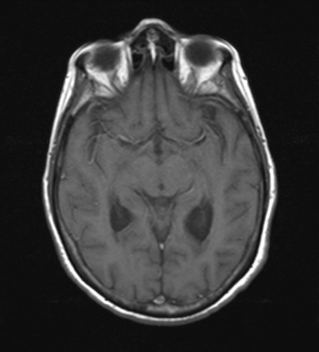 File:Cerebellar metastases (Radiopaedia 24038-24249 Axial T1 8).jpg