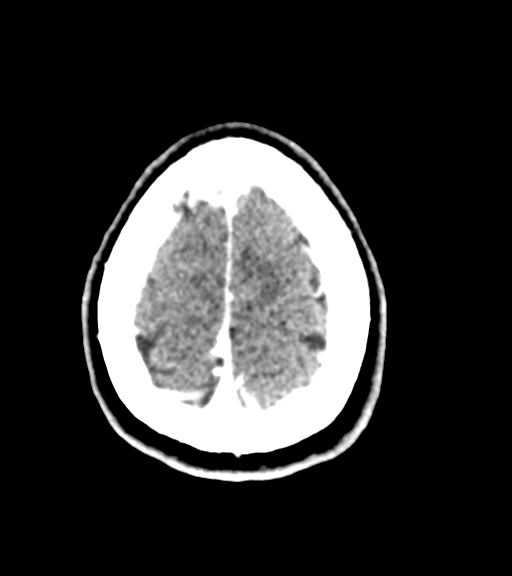 Cerebellar metastases - colorectal adenocarcinoma (Radiopaedia 40947-43652 Axial C+ 58).png