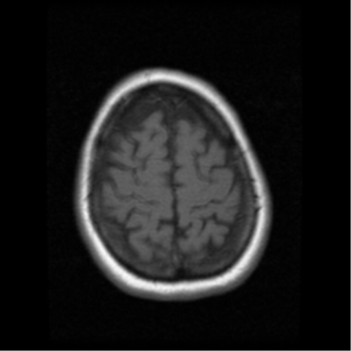 File:Cerebellar metastasis (cystic appearance) (Radiopaedia 41395-44262 Axial T1 19).png