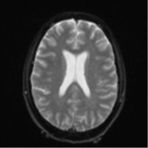 Cerebellar metastasis - adenocarcinoma lung (Radiopaedia 63184-71715 Axial DWI 19).png