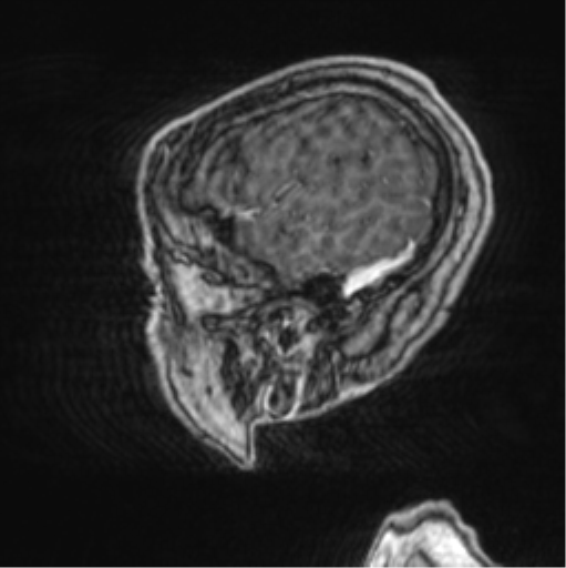 Cerebellar metastasis from lung adenocarcinoma (Radiopaedia 86690-102829 Sagittal T1 C+ 13).png