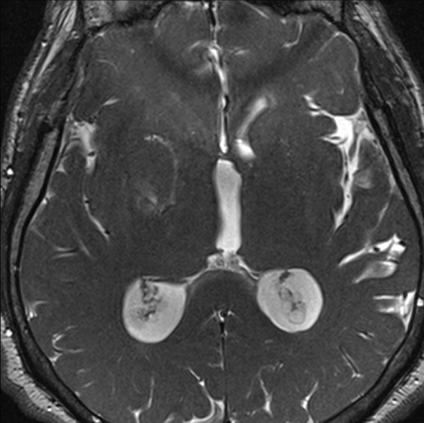 Cerebellopontine angle meningioma (Radiopaedia 24459-24764 I 55).jpg