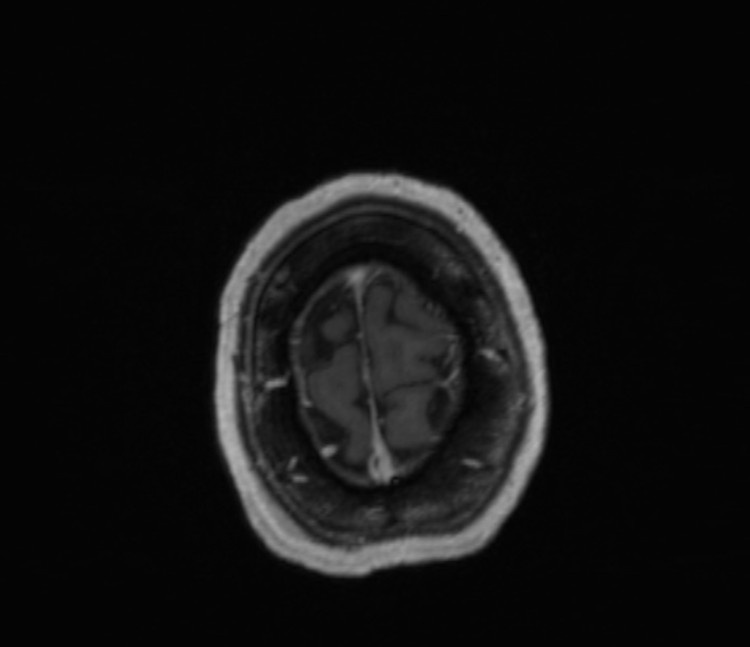 Cerebellopontine angle meningioma (Radiopaedia 35181-36715 Axial T1 C+ 8).jpg