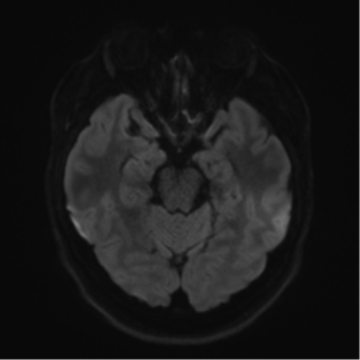 Cerebellopontine angle meningioma (Radiopaedia 48434-53348 Axial DWI 50).png